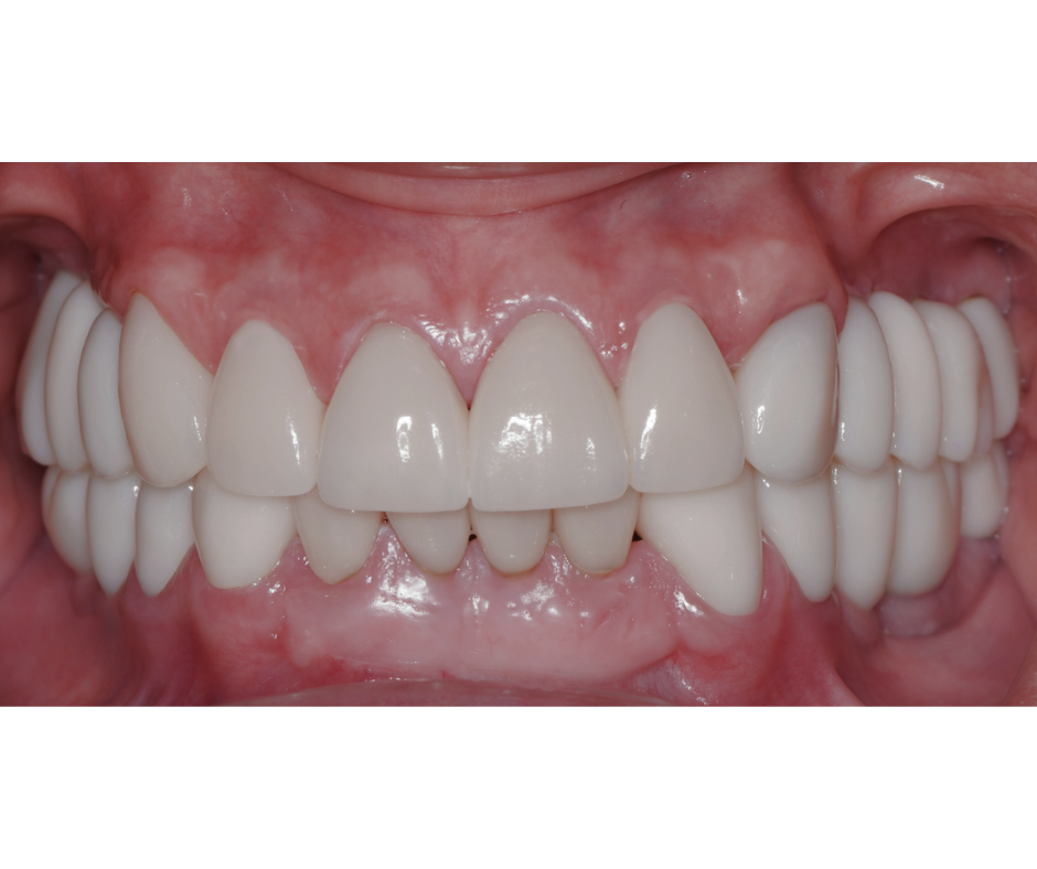 Full Mouth Rehabilitation — result