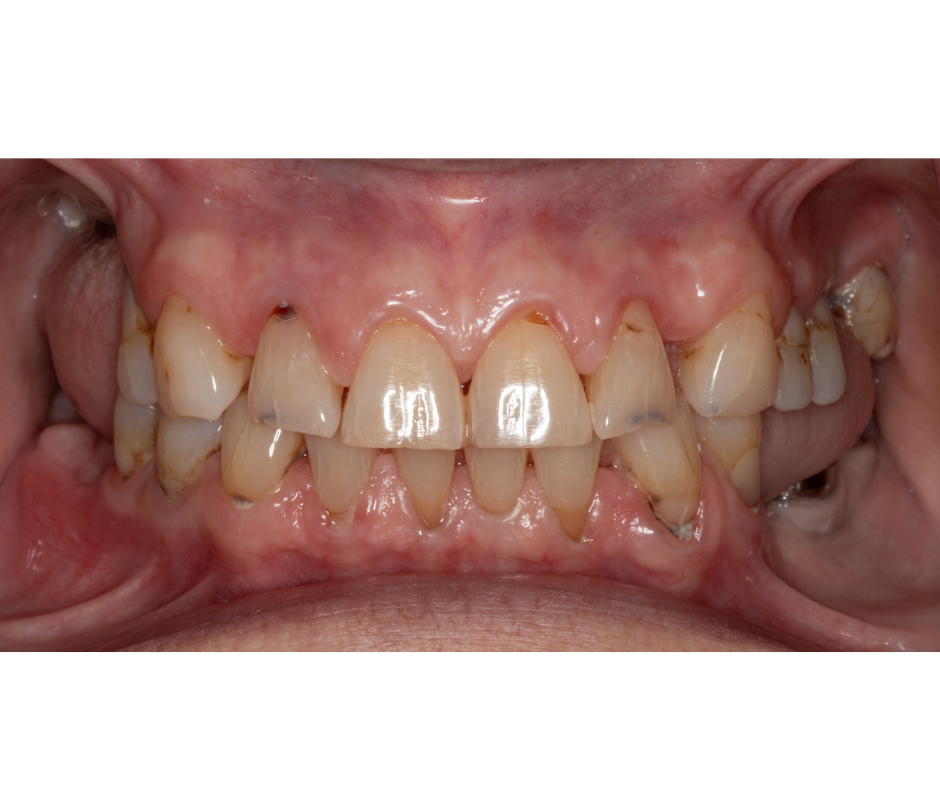 Full Mouth Rehabilitation — before treatment