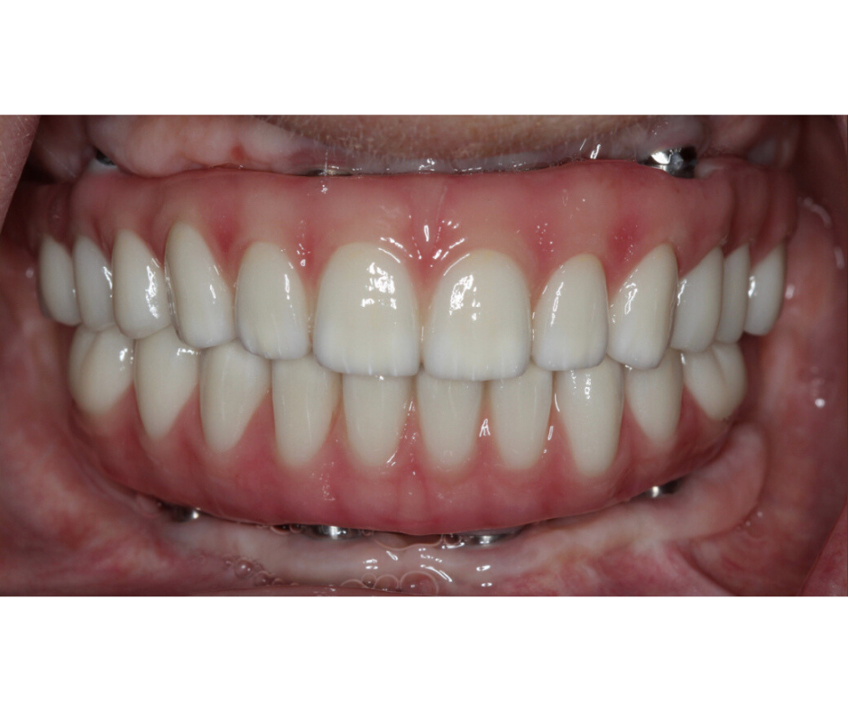 Full Arch Implants — result