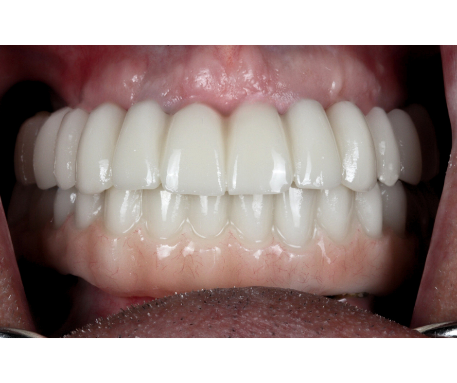 Failed Implant Correction — result