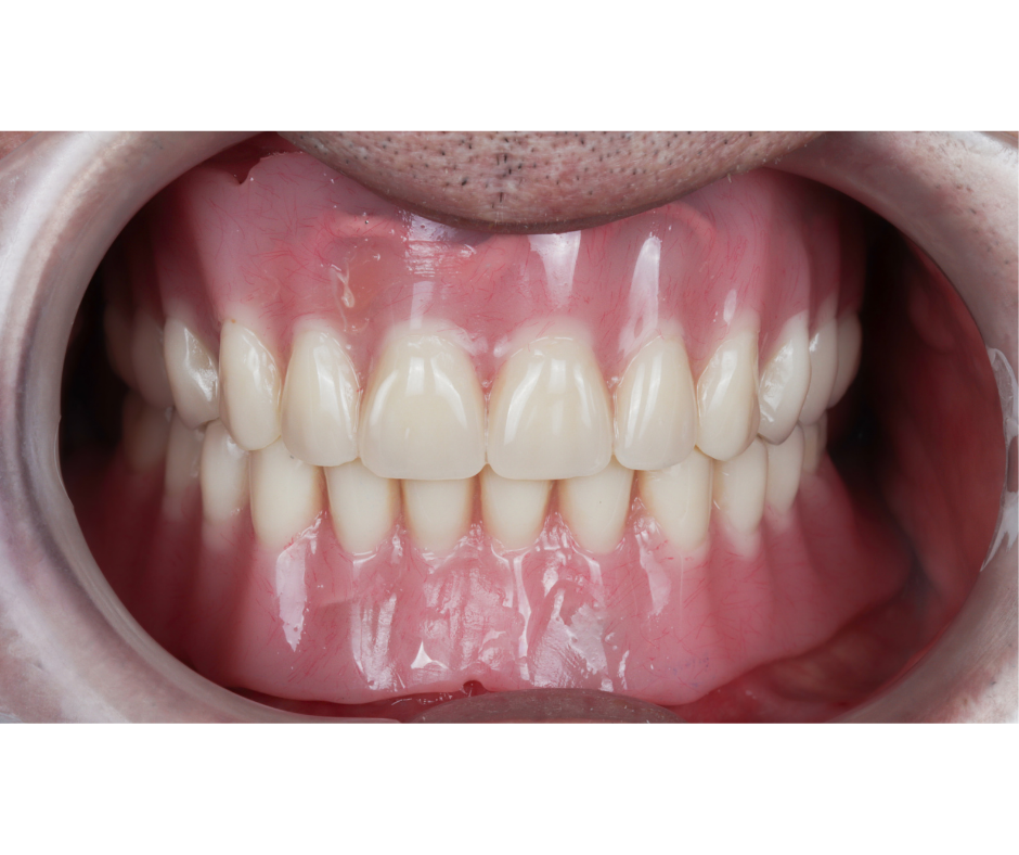 Overdenture Rehabilitation — result