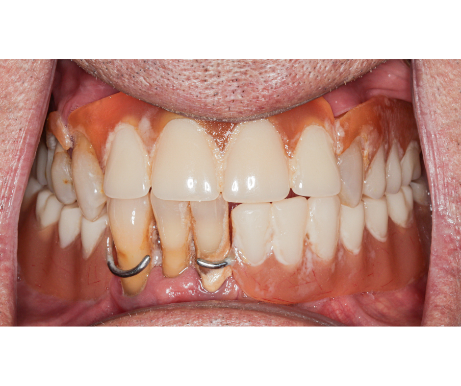 Overdenture Rehabilitation — before treatment