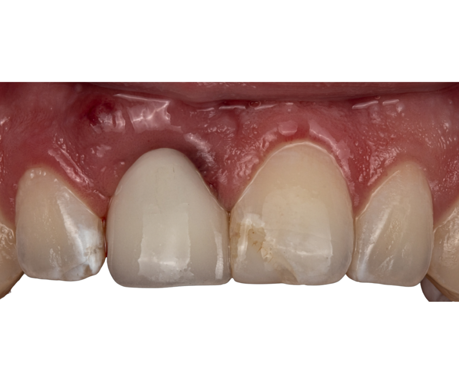 Immediate Implants — result