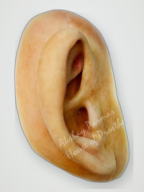 Hand-tinted silicone auricular prosthesis