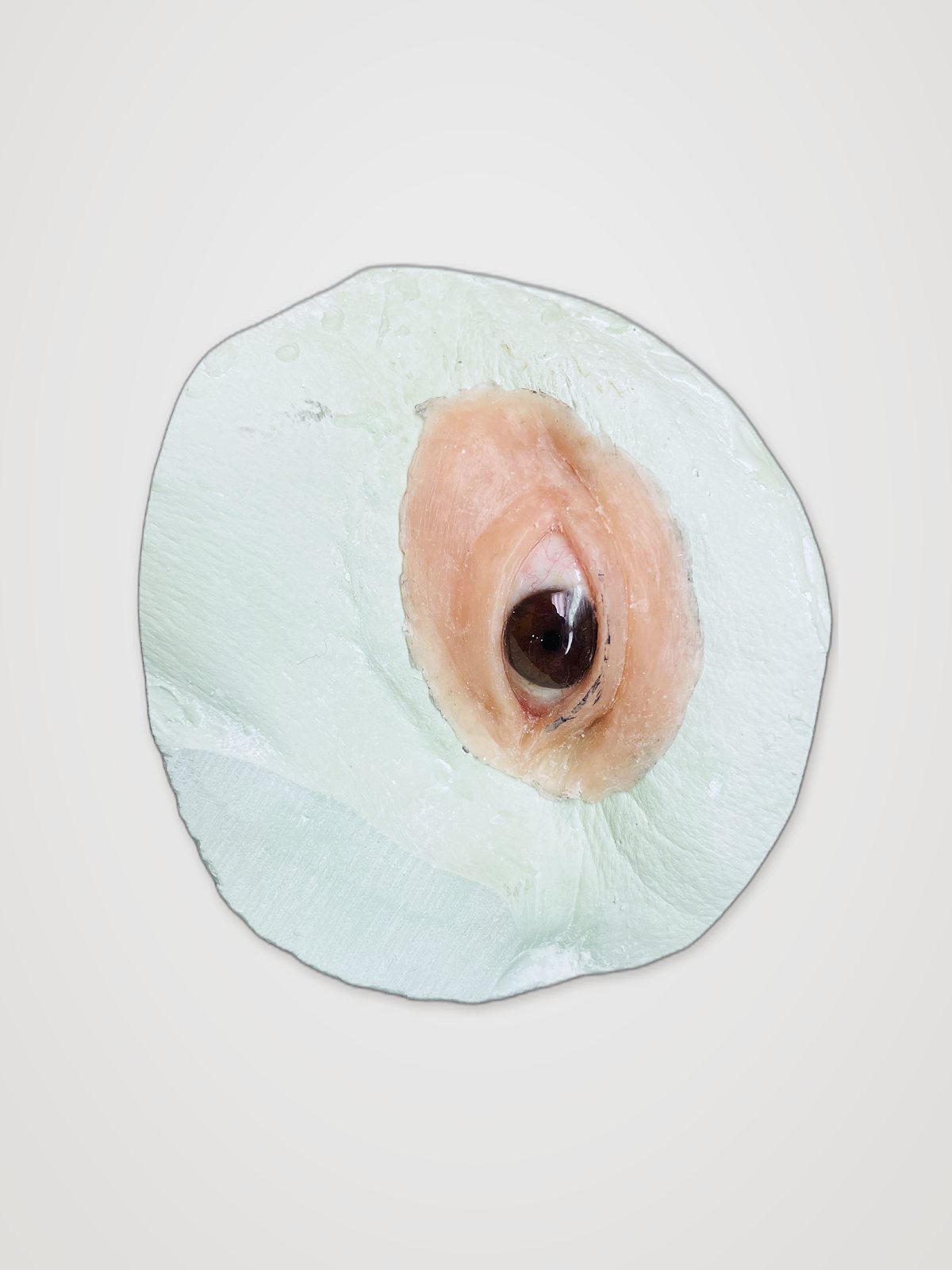 Orbital prosthesis with hand-painted ocular