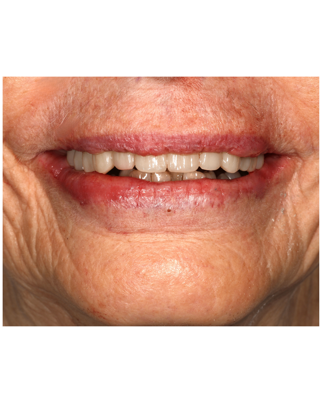 Complex Restorative Case — result
