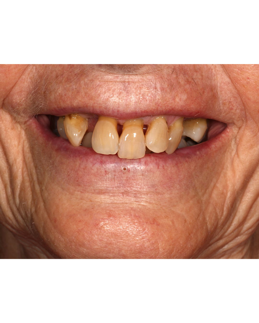 Complex Restorative Case — before treatment