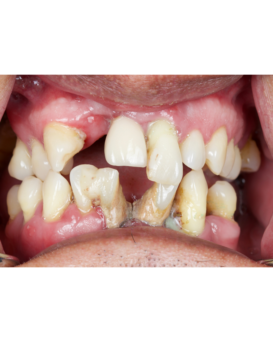Complex Rehabilitation — before treatment