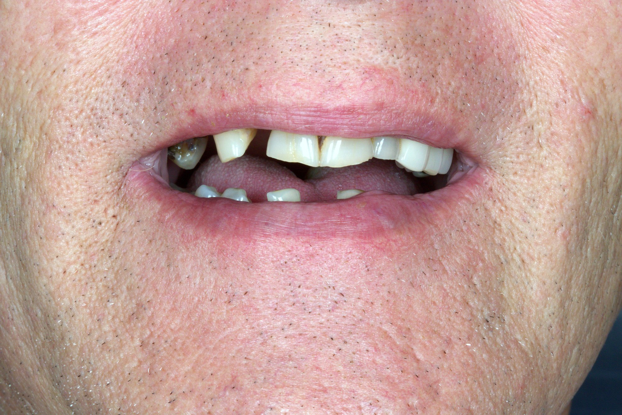 Failing Dentition, Rebuilt — before treatment