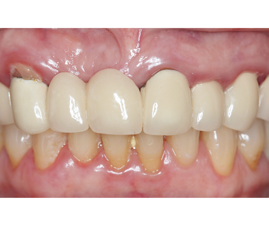 Veneers & Smile Design — before treatment